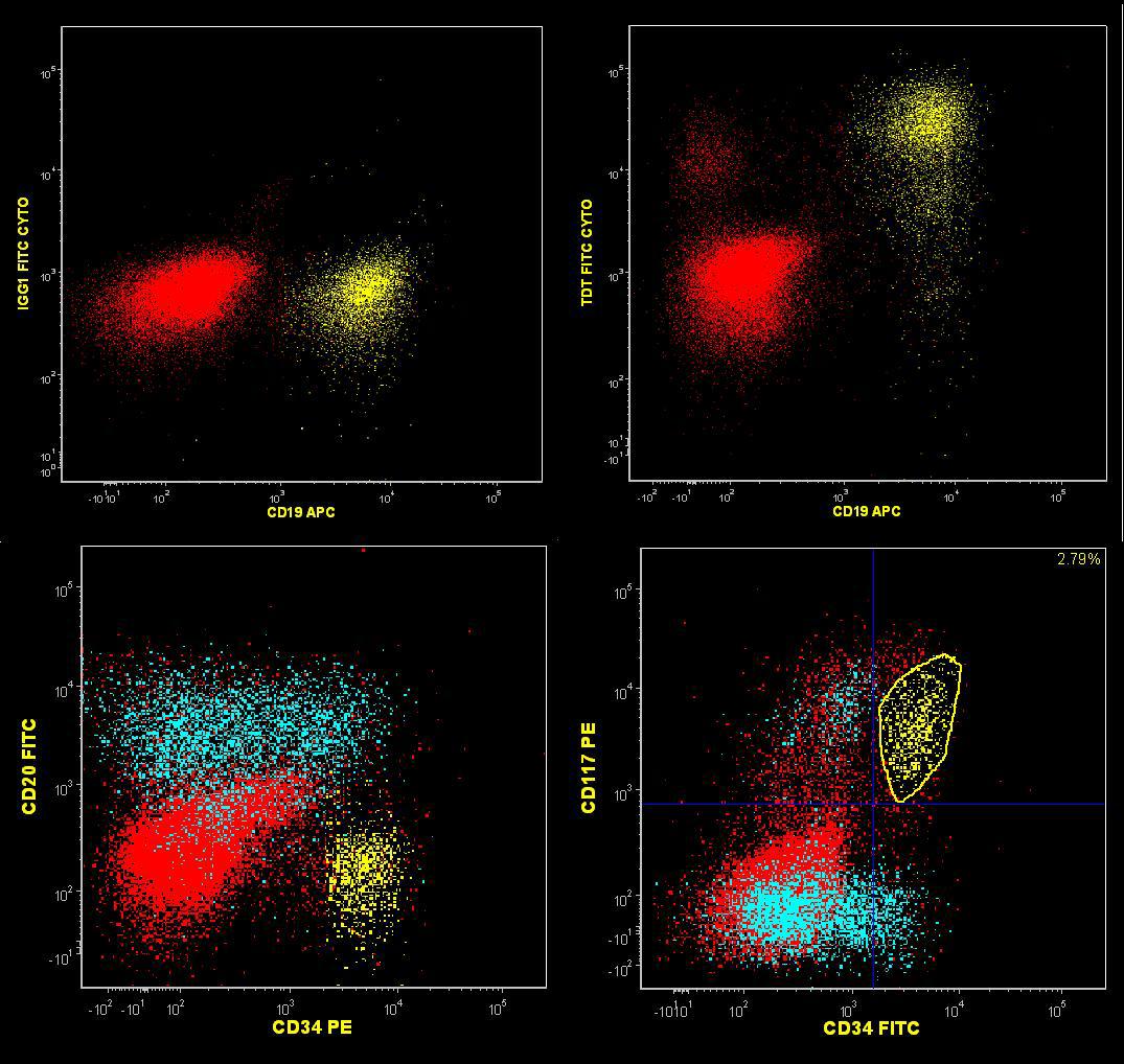 Flow cytometric analysis of BM aspirate with the B-lymphoid blasts (aqua). Myeloid blasts are shown in (yellow)