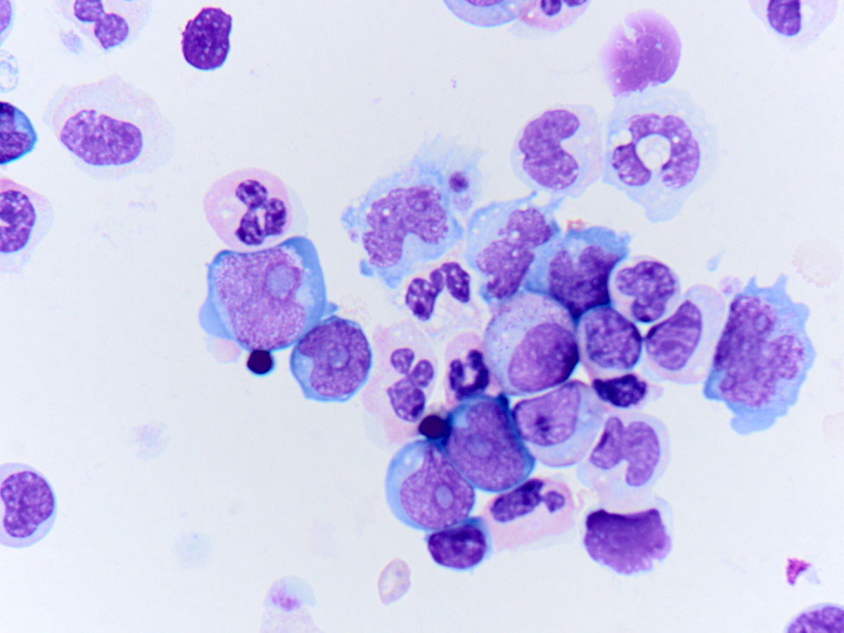Bone marrow cytospin