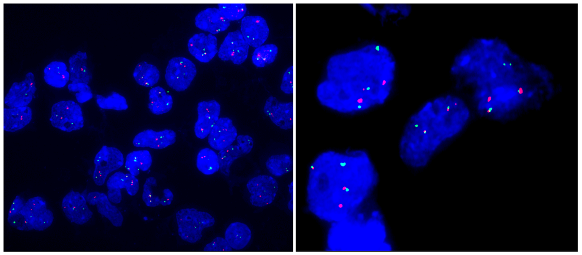 Image 16 BCR-ABL1 FISH