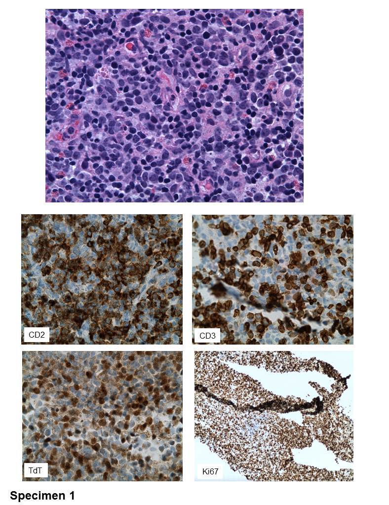 Specimen1 Fine needle core biopsy of left posterior neck lymph node