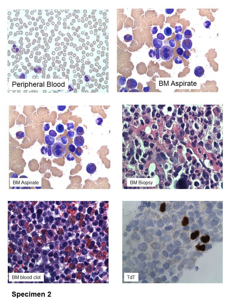 specimen 2 Bone marrow biopsy,blood clot and aspirate