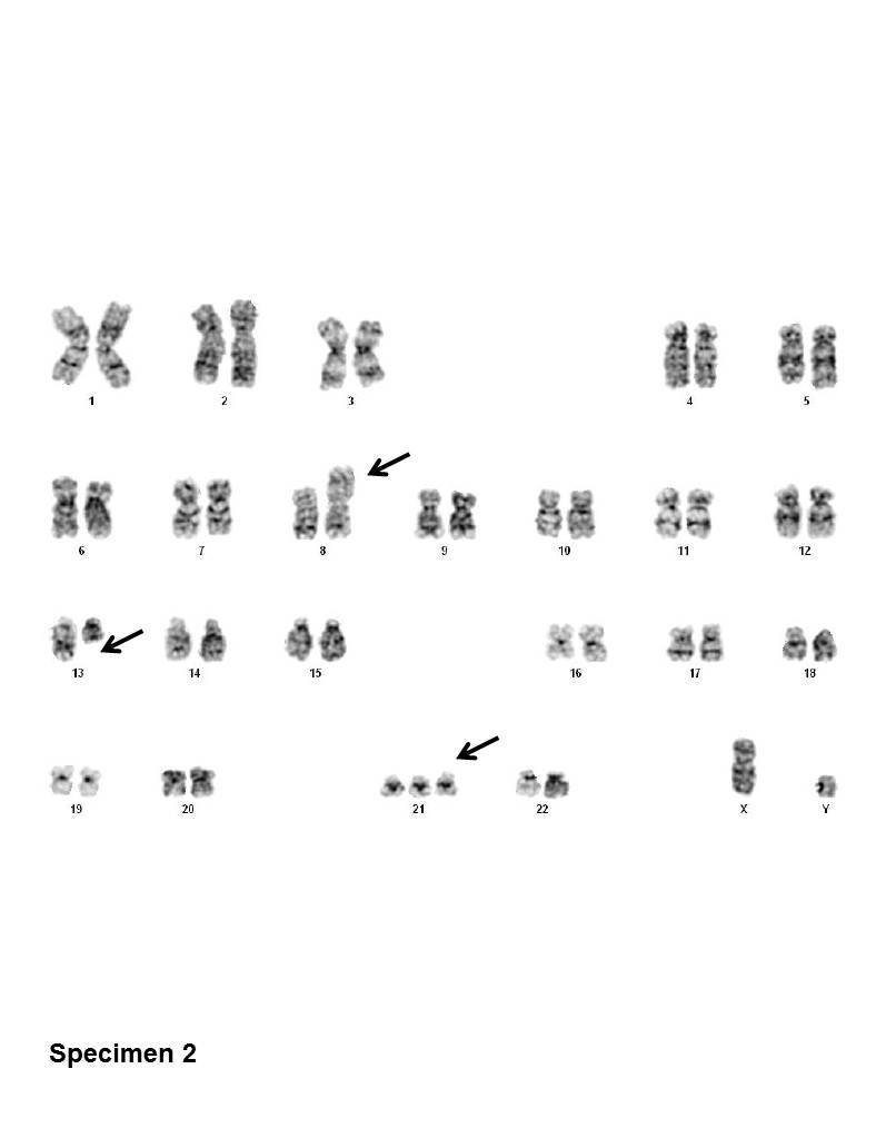 specimen 2 Bone marrow cytogenetics