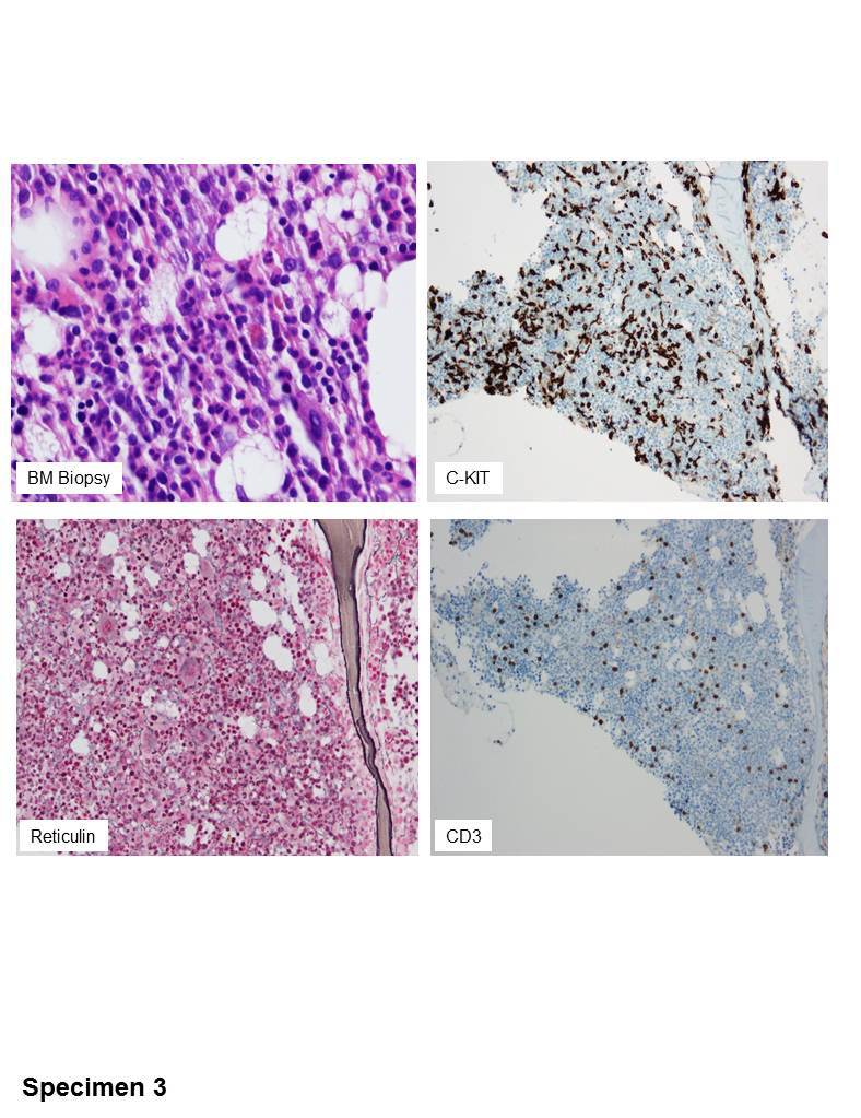 Specimen 3  bone marrow after one month of HyperCVD treatment