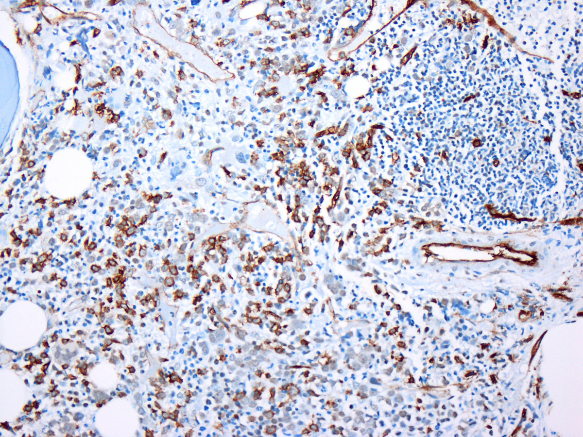 Figure 3. Initial bone marrow biopsy: Immunohistochemistry for CD34 reveals increased blasts, comprising 10-15% of the cellularity.