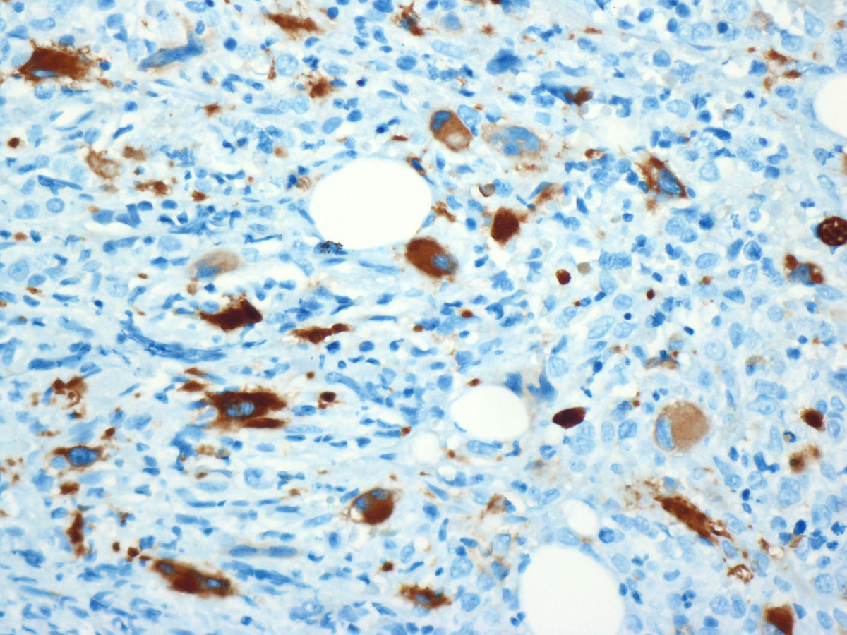 Figure 4. Initial bone marrow biopsy: Immunohistochemistry for CD61 highlights dysplastic megakaryocytes.