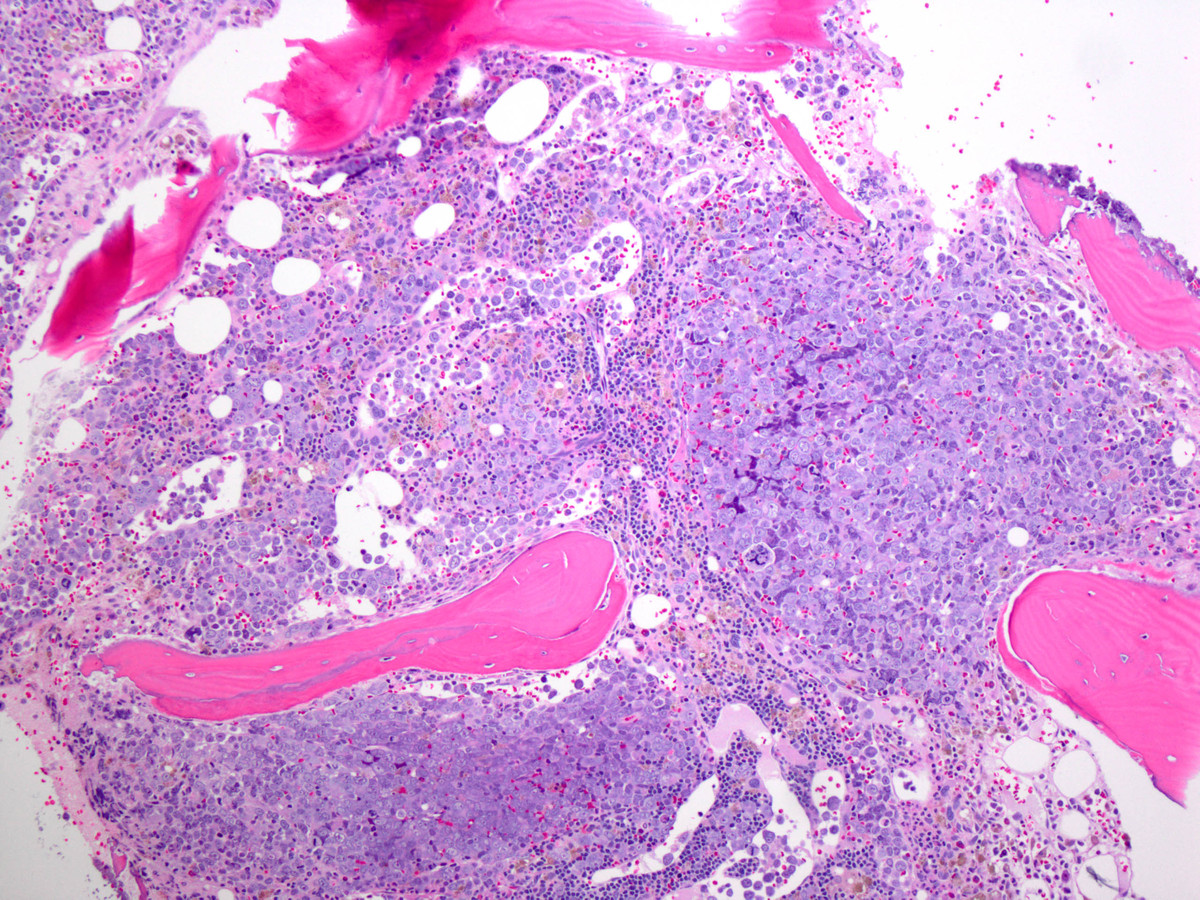 Figure 5. Final bone marrow biopsy showing progression to pure erythroid leukemia: The markedly hypercellular bone marrow contains sheets of large blasts, as well as persistent CLL aggregates and dysplastic megakaryocytes (H&E).