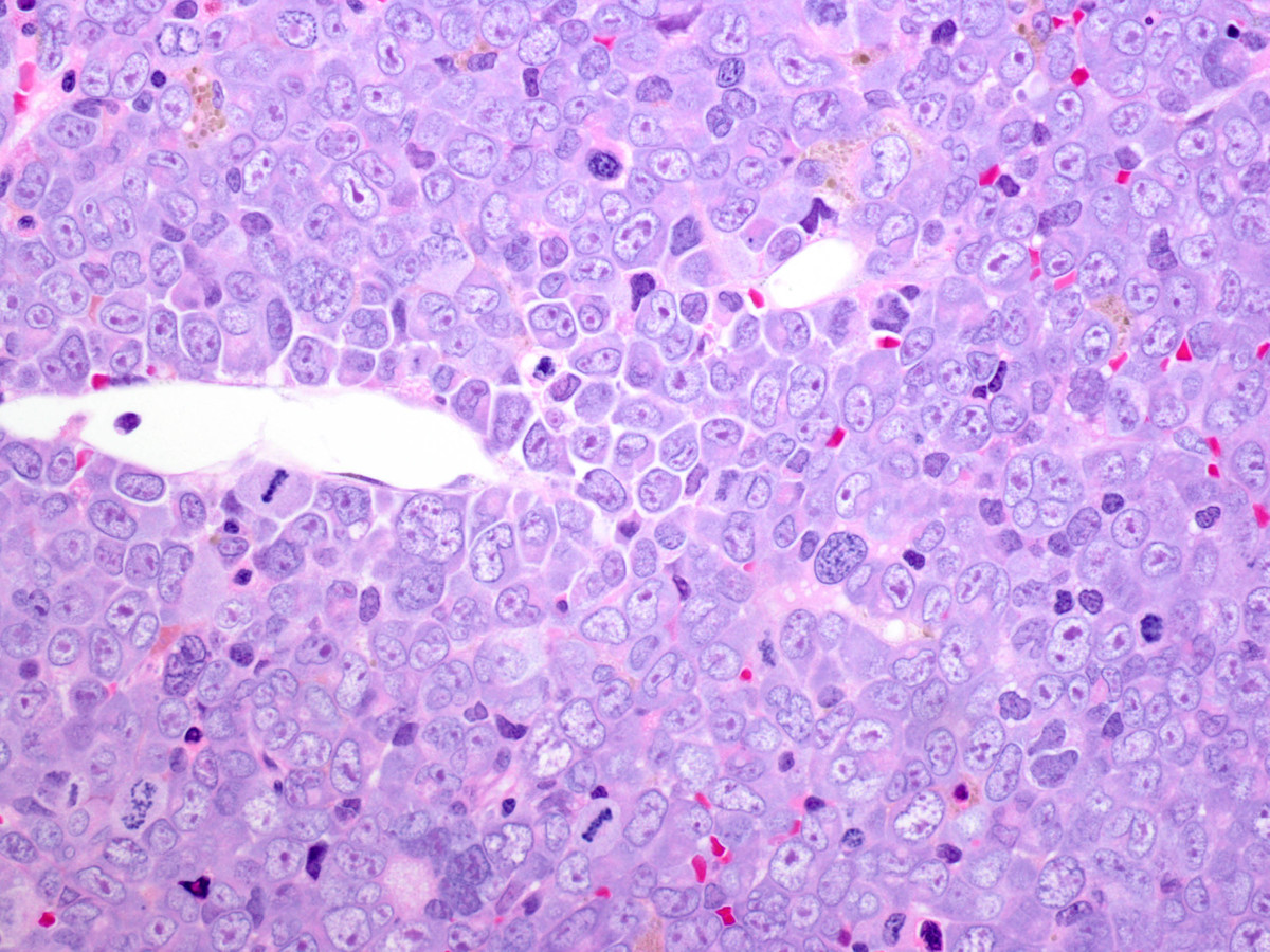 Figure 6. Final bone marrow biopsy showing progression to pure erythroid leukemia: The blasts contain vesicular chromatin, multiple nucleoli, and smooth, amphophilic chromatin, consistent with erythroblasts (H&E).