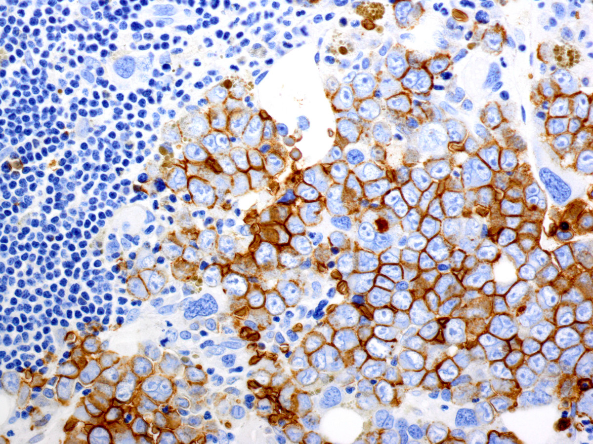 Figure 7. Final bone marrow biopsy showing progression to pure erythroid leukemia: By immunohistochemistry, the blasts are glycophorin positive, confirming erythroid lineage.