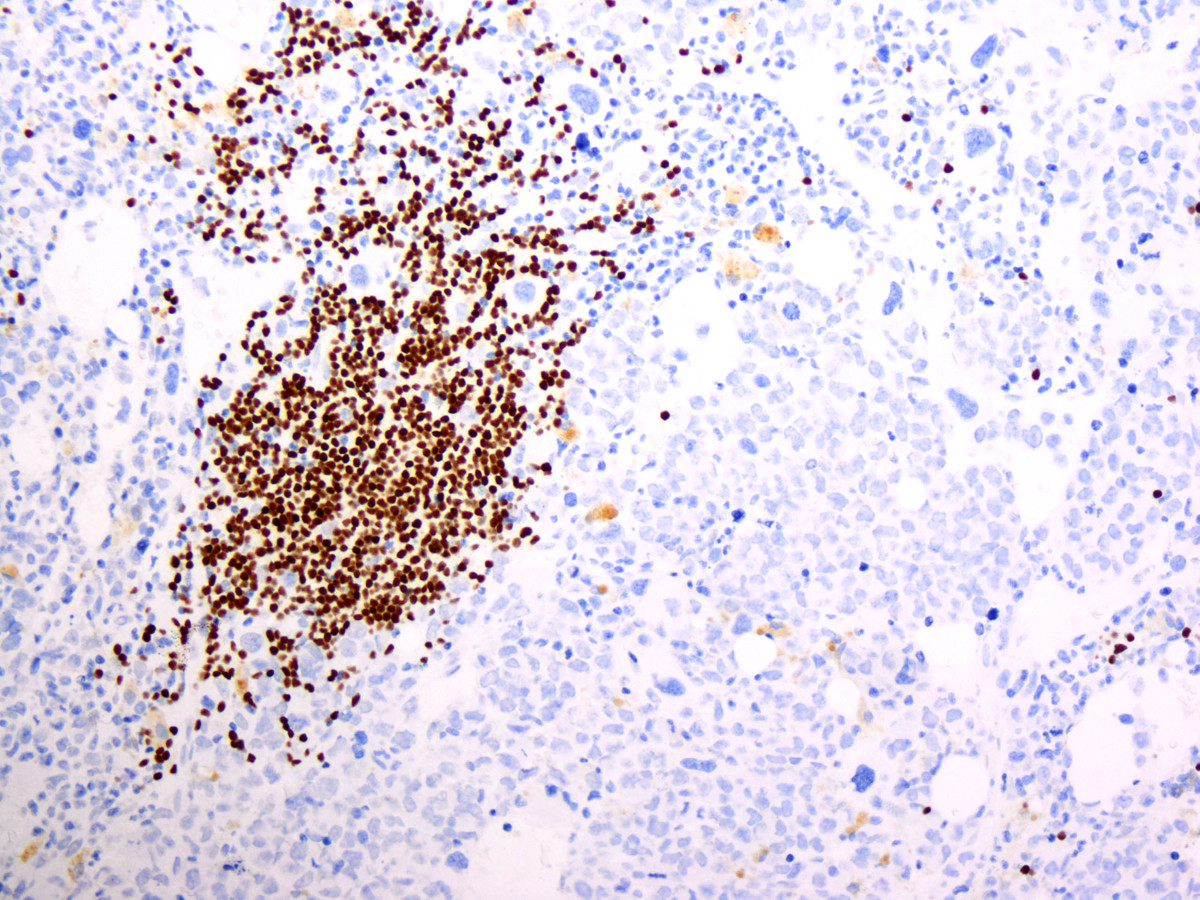 Figure 8. Final bone marrow biopsy showing progression to pure erythroid leukemia: The background small lymphocytes are PAX5 positive, consistent with CLL.