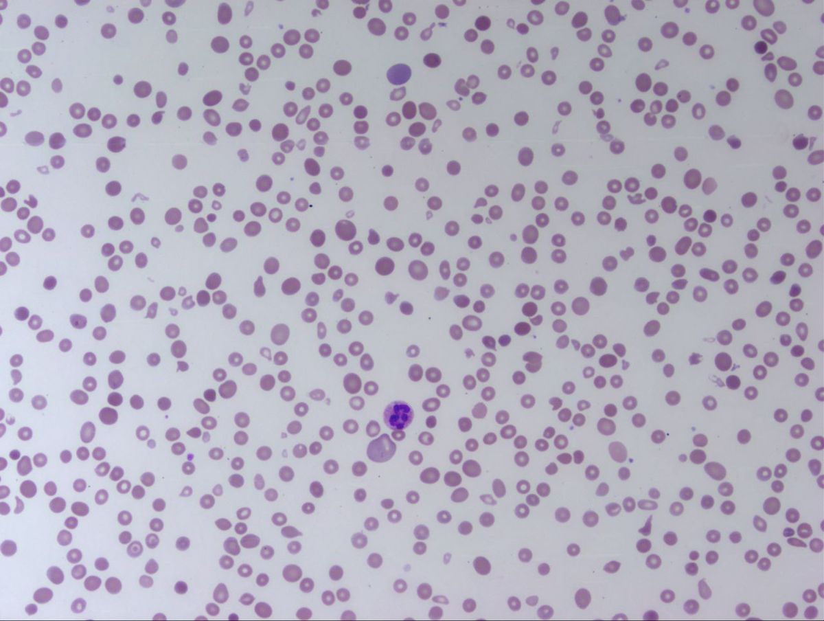 Peripheral Smear 1