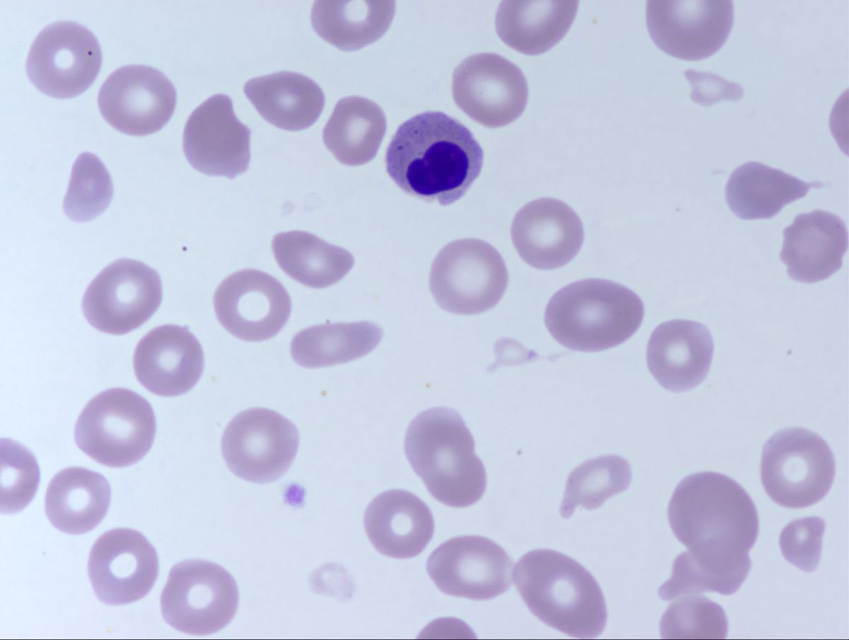 Peripheral Smear 2