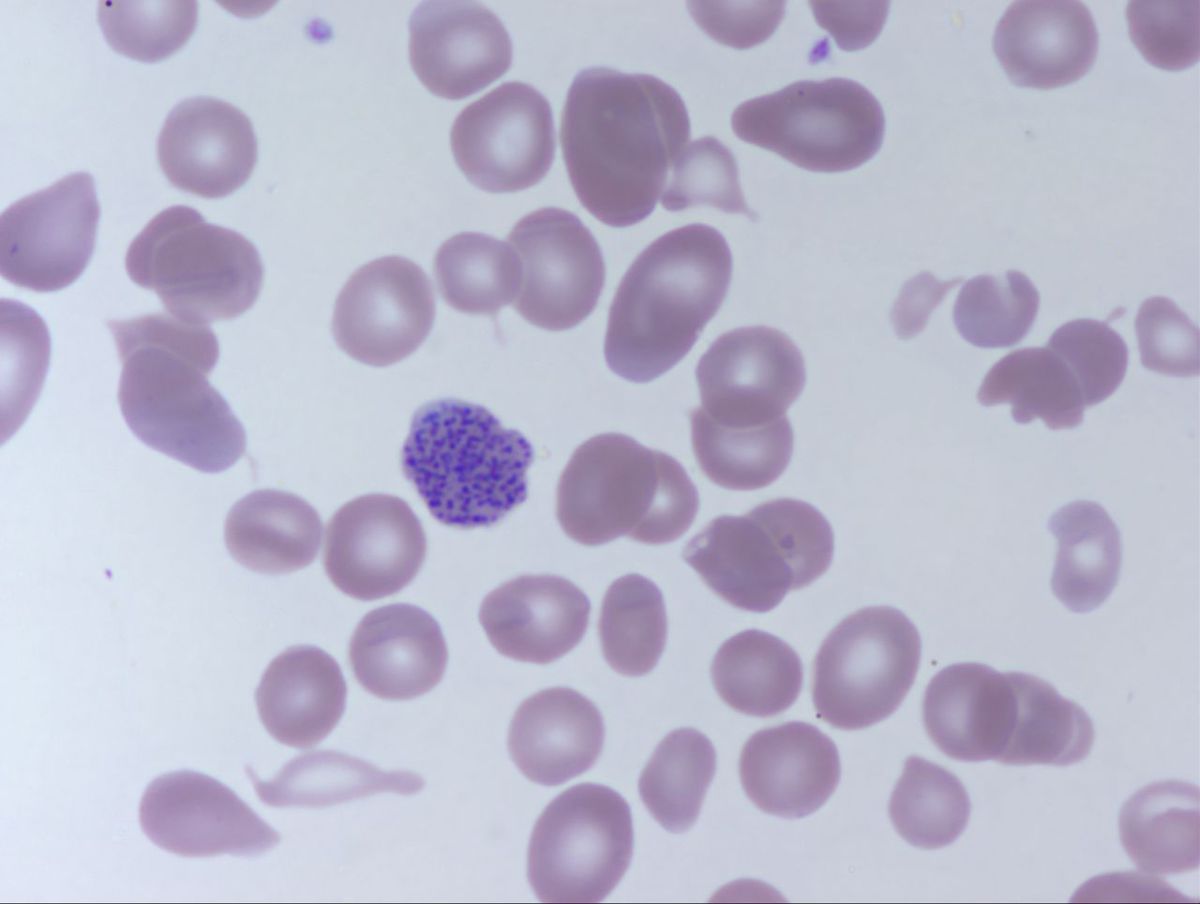 Peripheral Smear 3