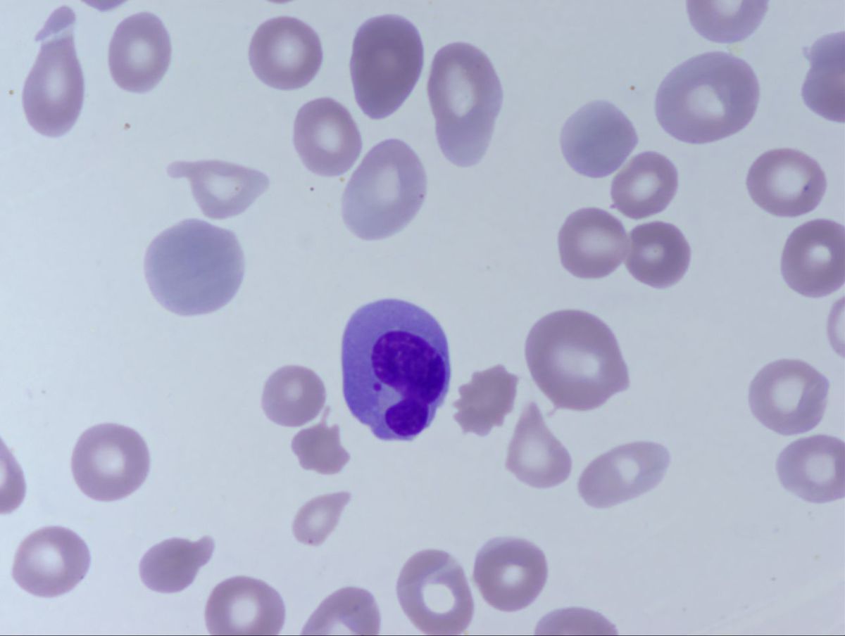 Peripheral Smear 4