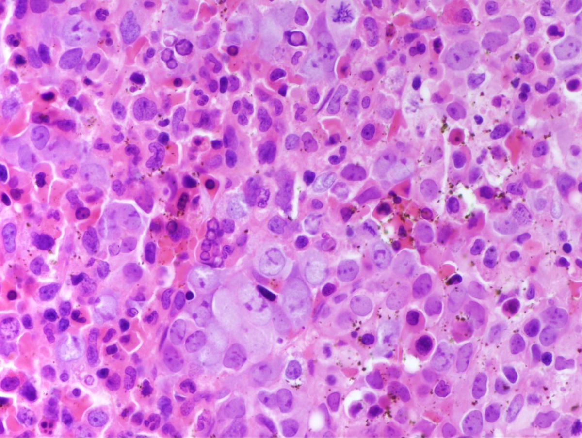 Bone Marrow Core 5