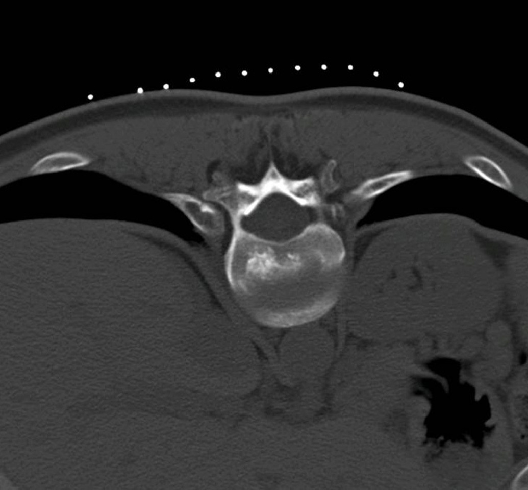 CT scan of L3 vertebral mass