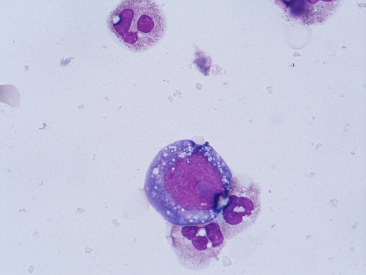 Wright stained smear form L3 mass biopsy