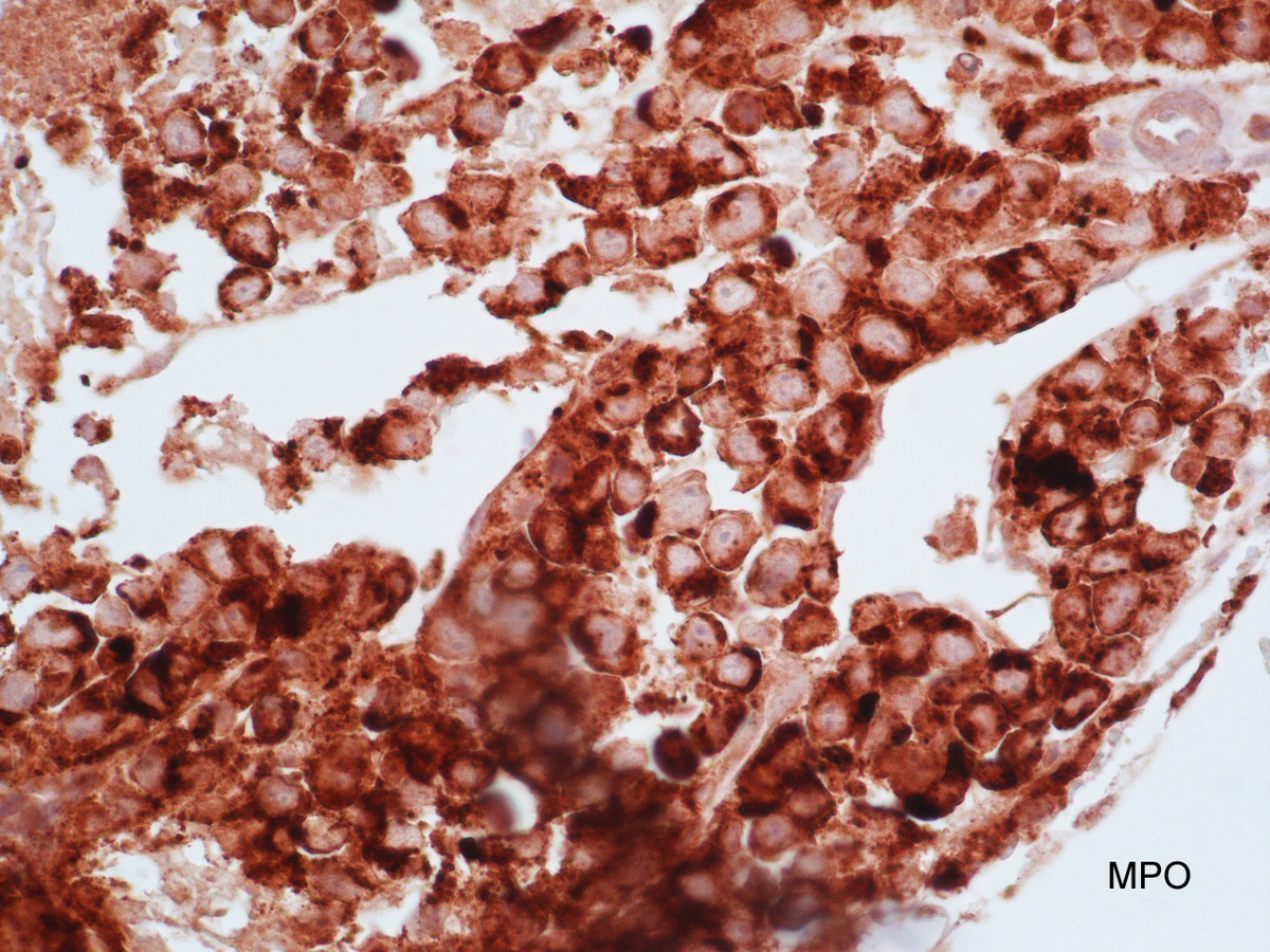 Myeloperoxidase (MPO)