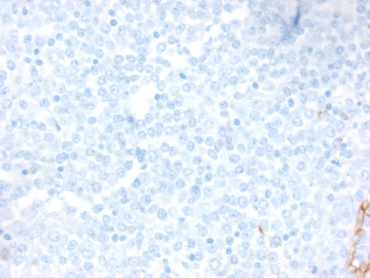 Skin Biopsy: CD34 immunohistochemical stain, 400x