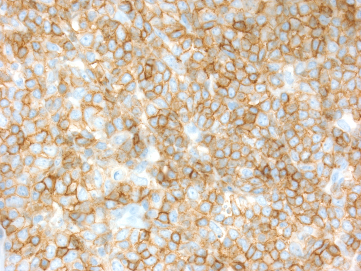 Skin Biopsy: CD45 immunostain 400x