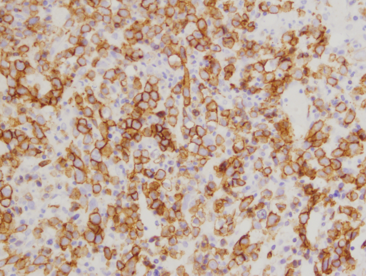 E-Cadherin immunostain, 400X