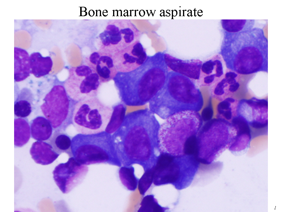 Bone marrow aspirate