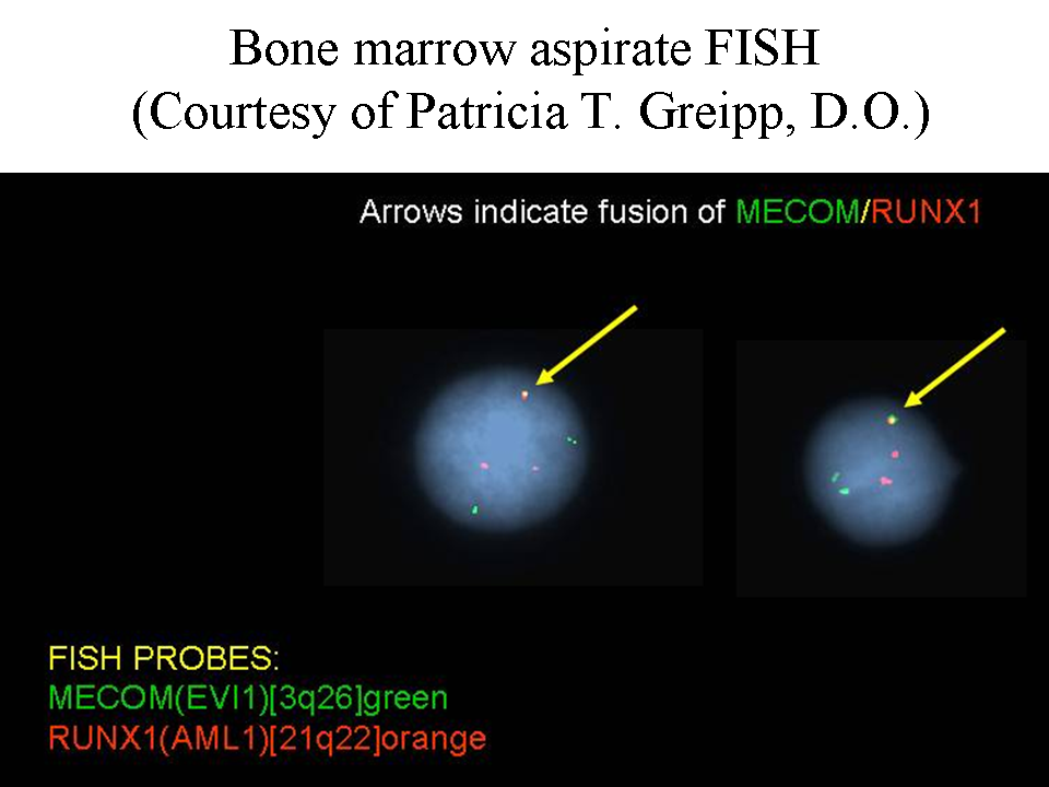 Bone marrow aspirate FISH (Courtesy of Patricia T. Greipp, D.O.)