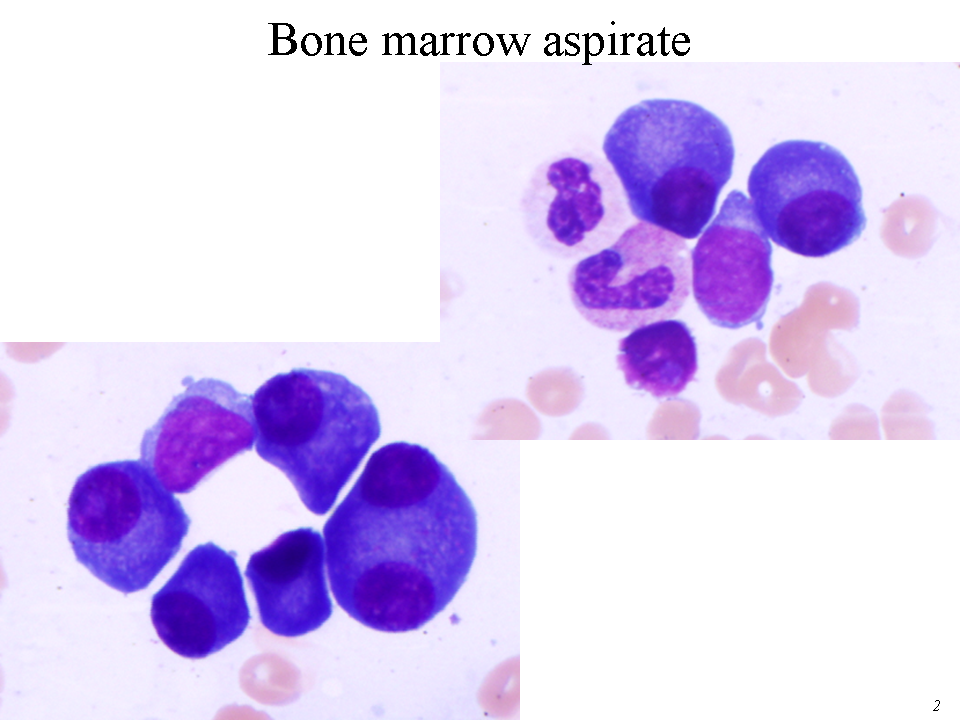 Bone marrow aspirate