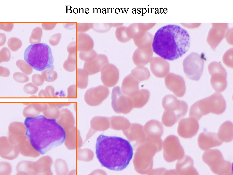 Bone marrow aspirate