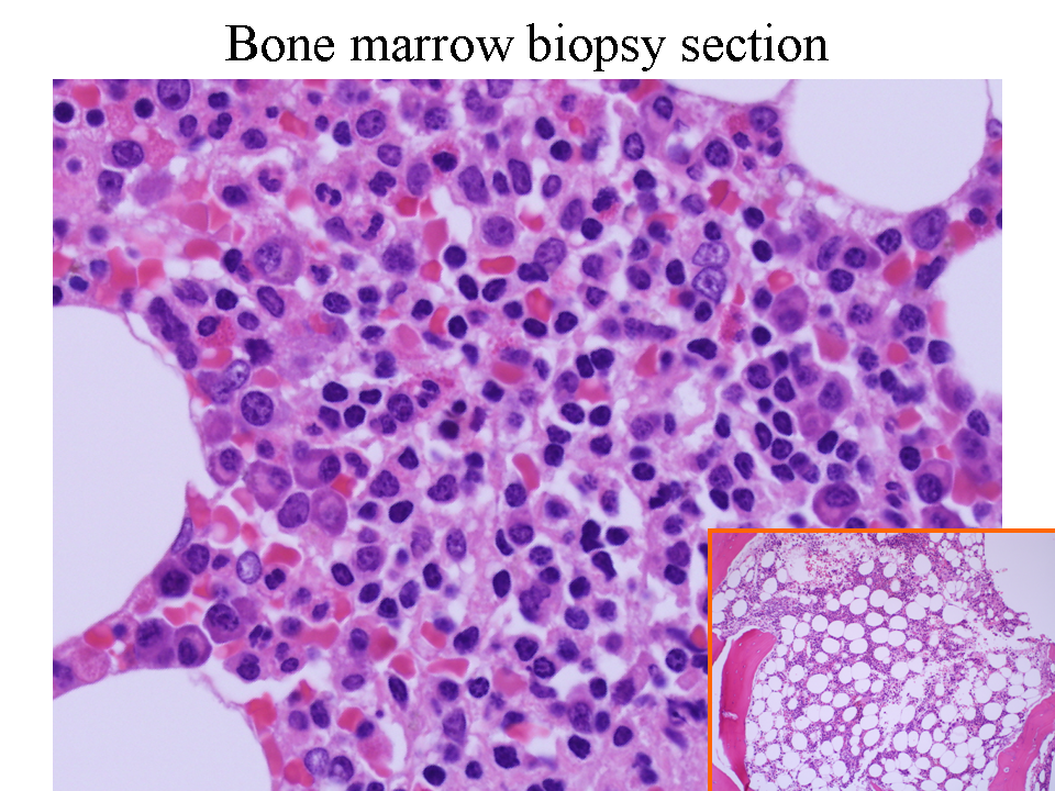 Bone marrow biopsy section