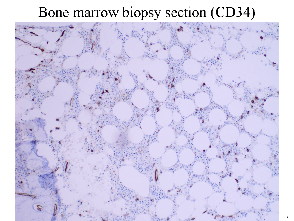 Bone marrow biopsy section (CD34)