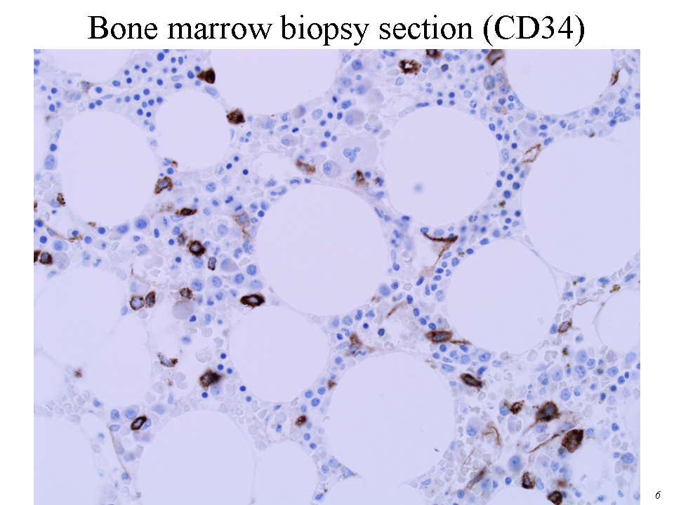 Bone marrow biopsy section (CD34)