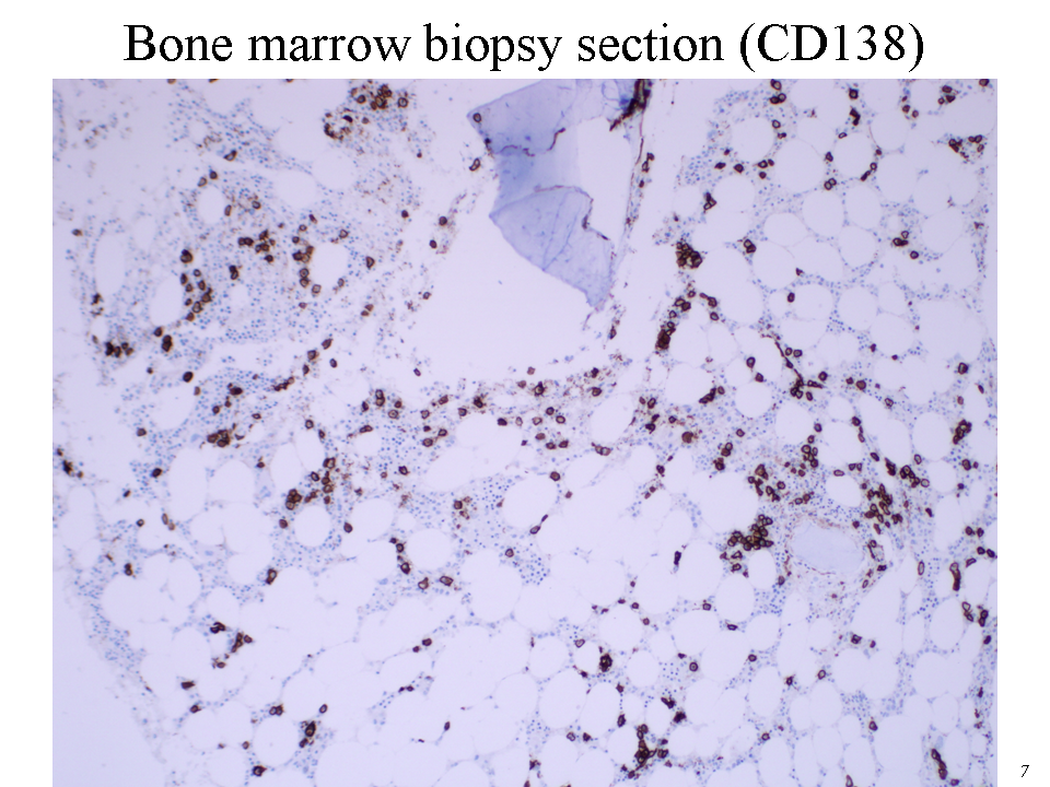 Bone marrow biopsy section (CD138)