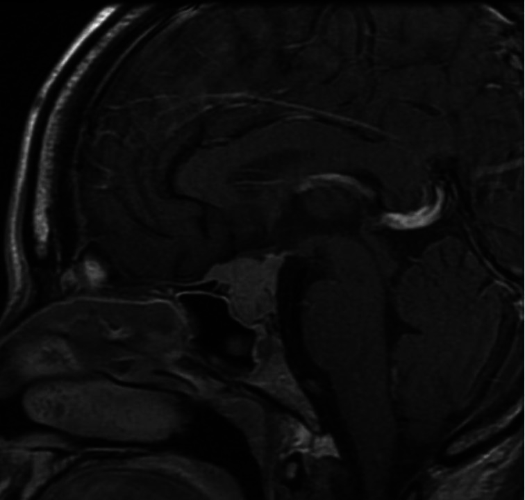 MRI
