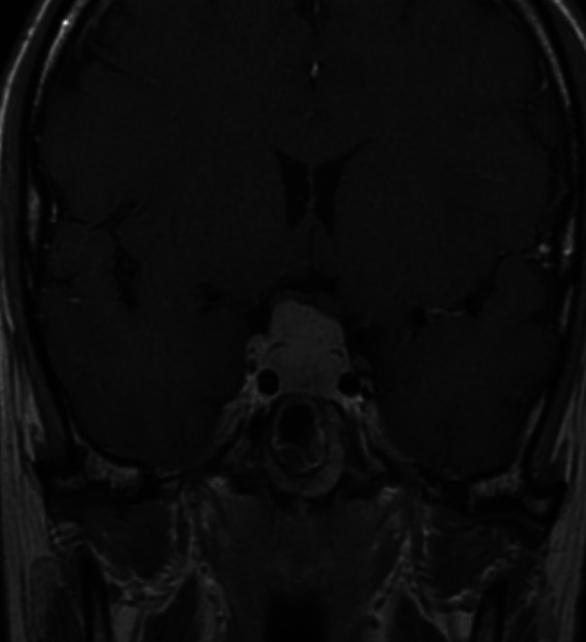 MRI