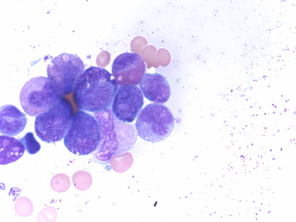 Bone marrow aspirate -2