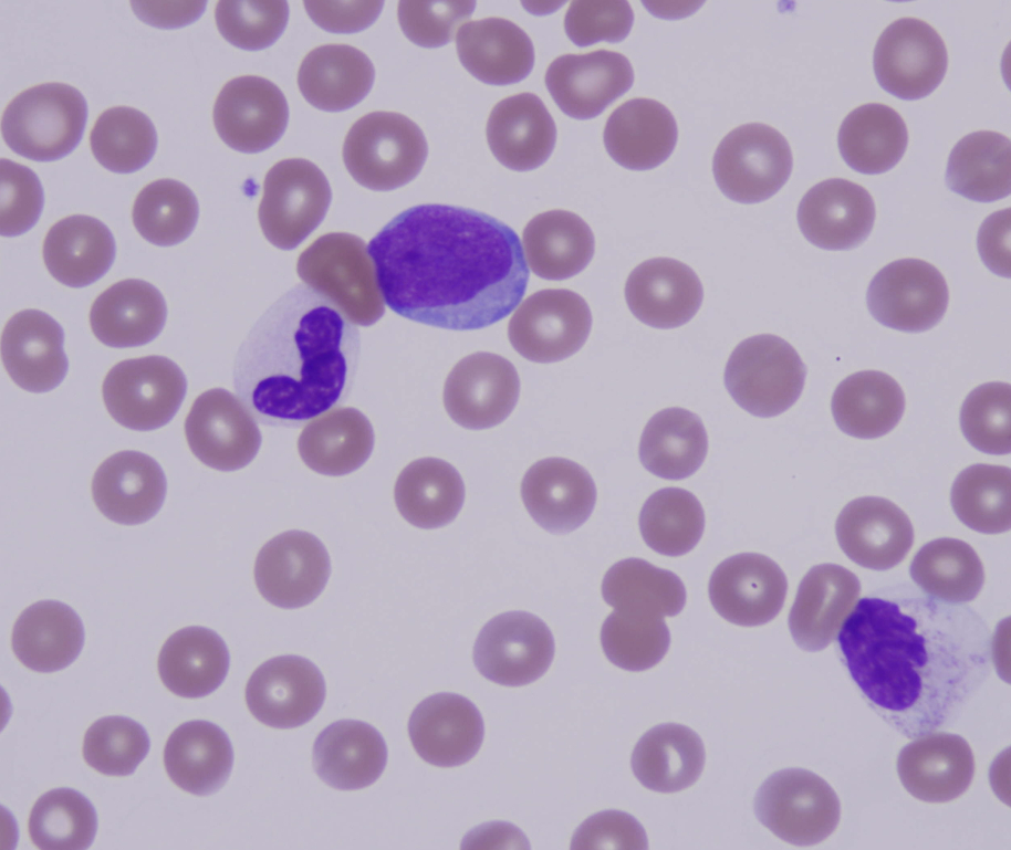 Peripheral smear showing blasts and dysplastic neutrophils