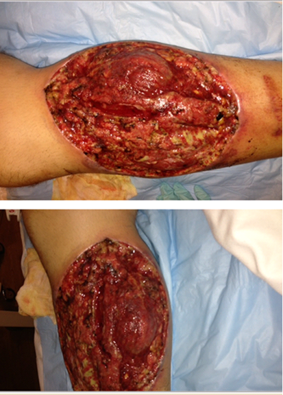 Lower leg lesion upon admission (status post 3 surgical debridements).