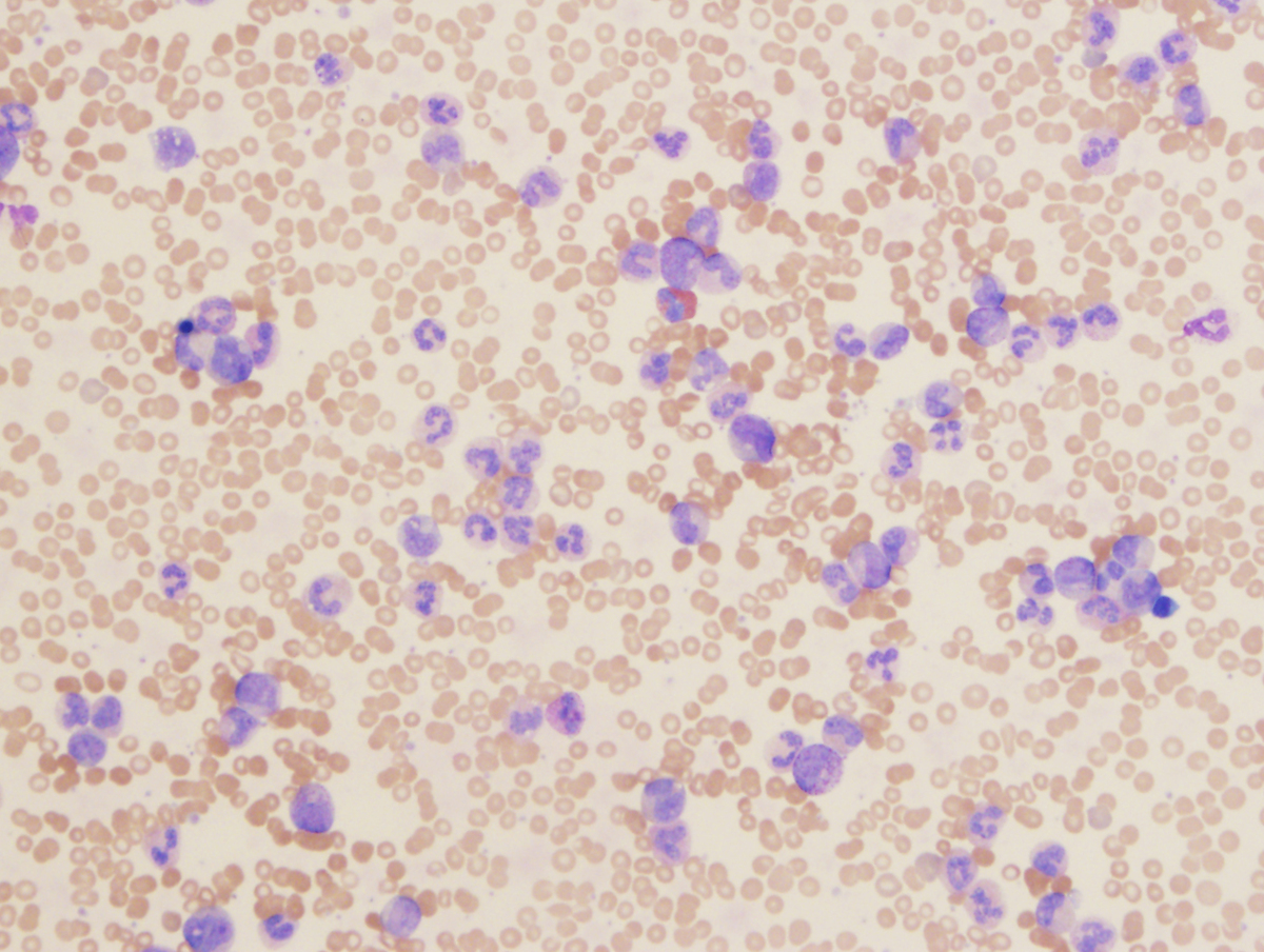 Peripheral Blood smear showed markedly increased granulocytes