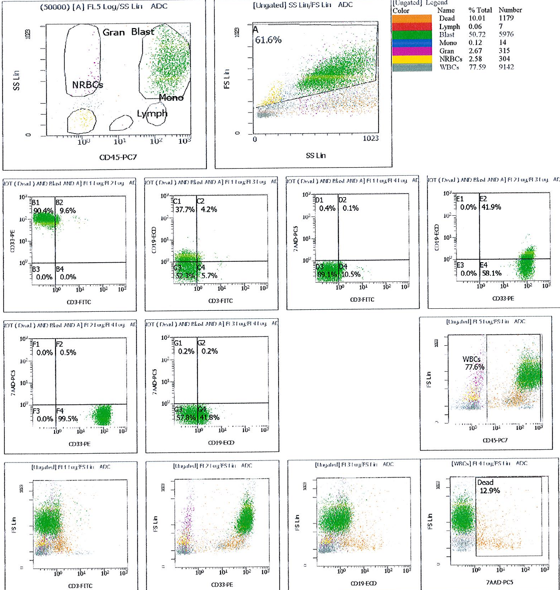 Flow cytometry histograms showing CD33+ immature cell population with bright CD45 expression and very high side and forward scatter
