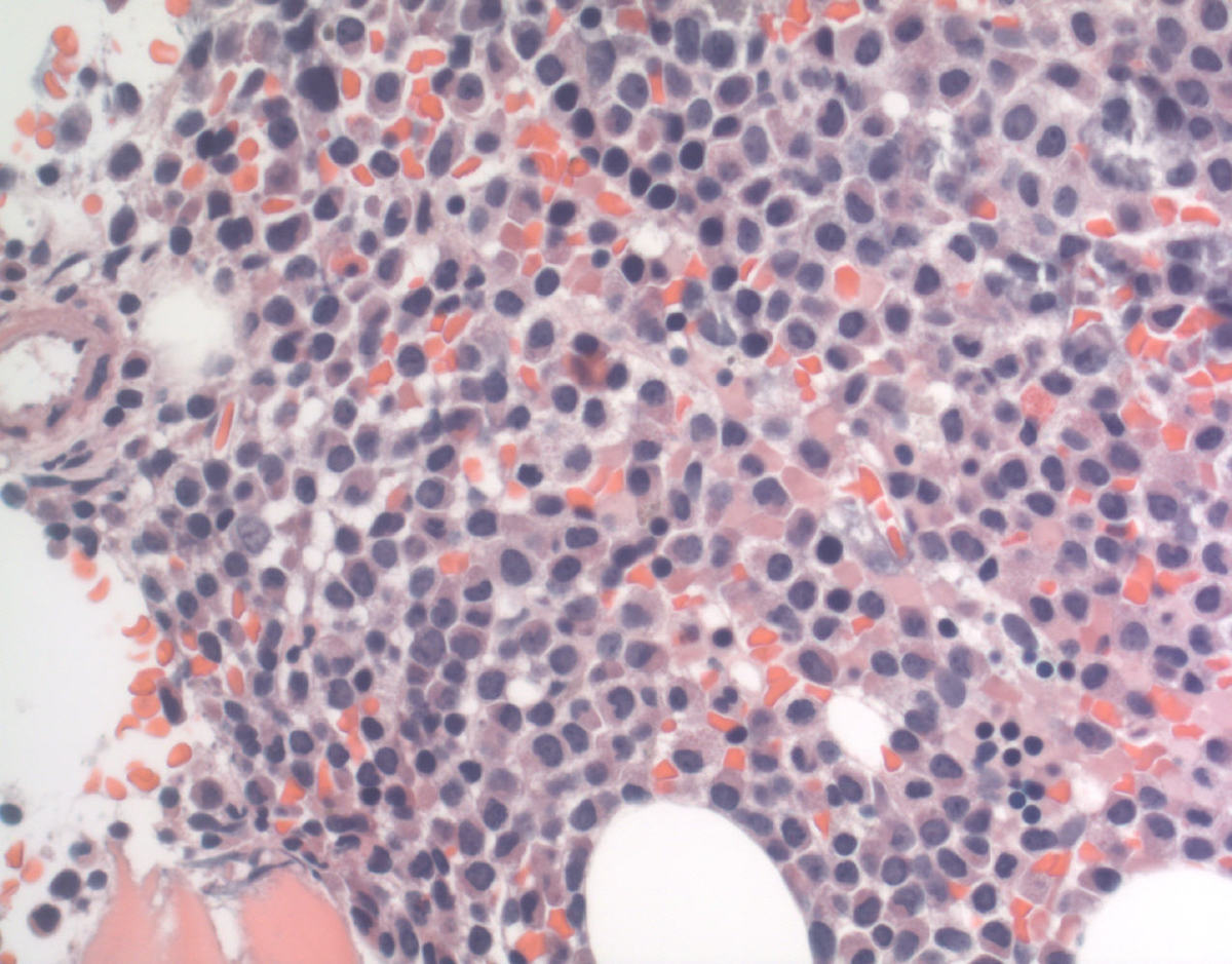 Core biopsy, low magnification