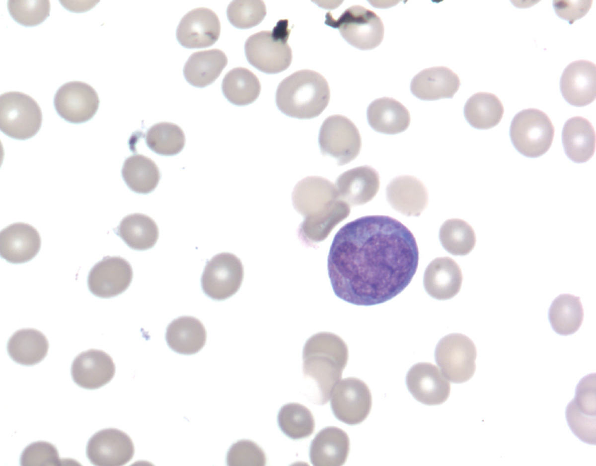 Abnormal promyelocytes in the aspirate