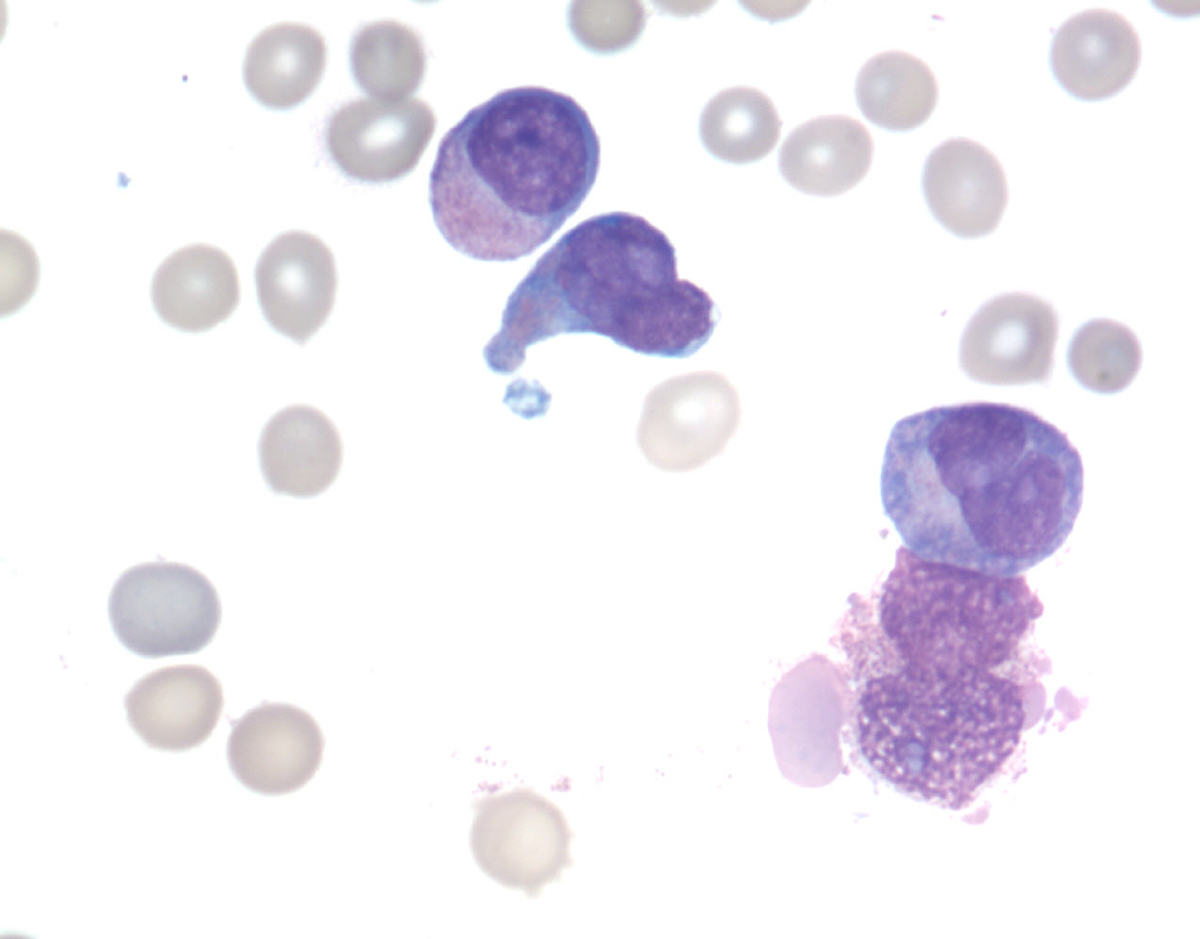 Abnormal promyelocytes in the aspirate
