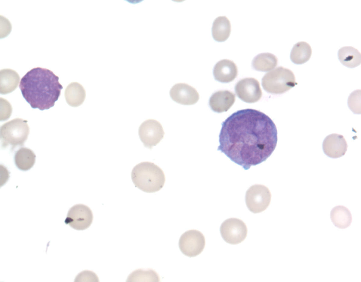 Abnormal promyelocytes in the aspirate