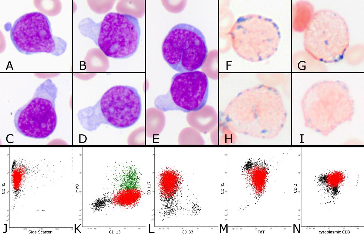 Figure 1. A-E blasts; F-I cytochemical myeloperoxidase ( MPO) on peripheral smear; J-N Flow results showing blasts within the gated region ( red) expressing cytoplasmic CD3, TdT, MPO(minor subset-green) and myeloid associated antigens CD13, CD33.