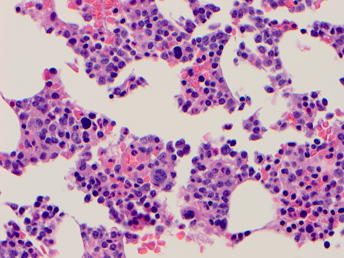 Additional figure 1: H&E (dysplastic megakaryocytes)