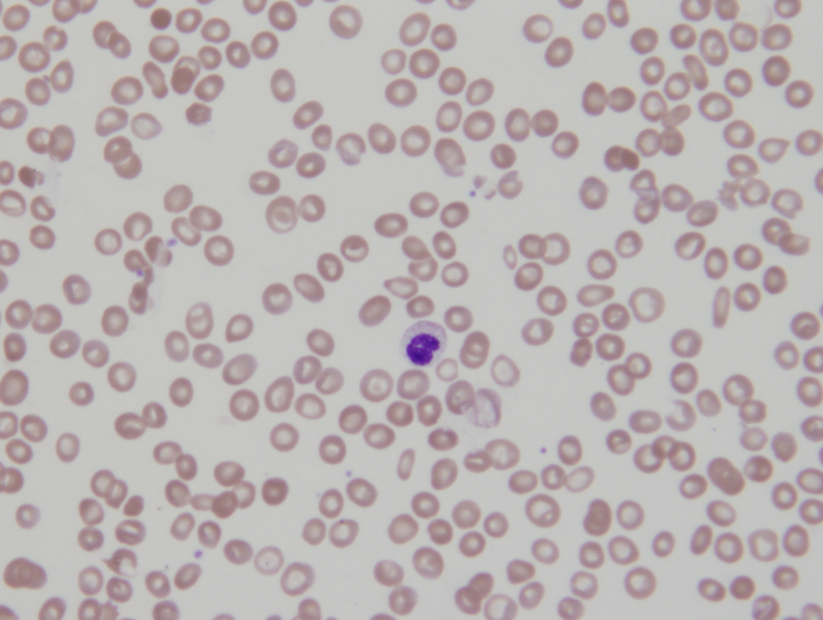 Peripheral blood: dysplastic neutrophils