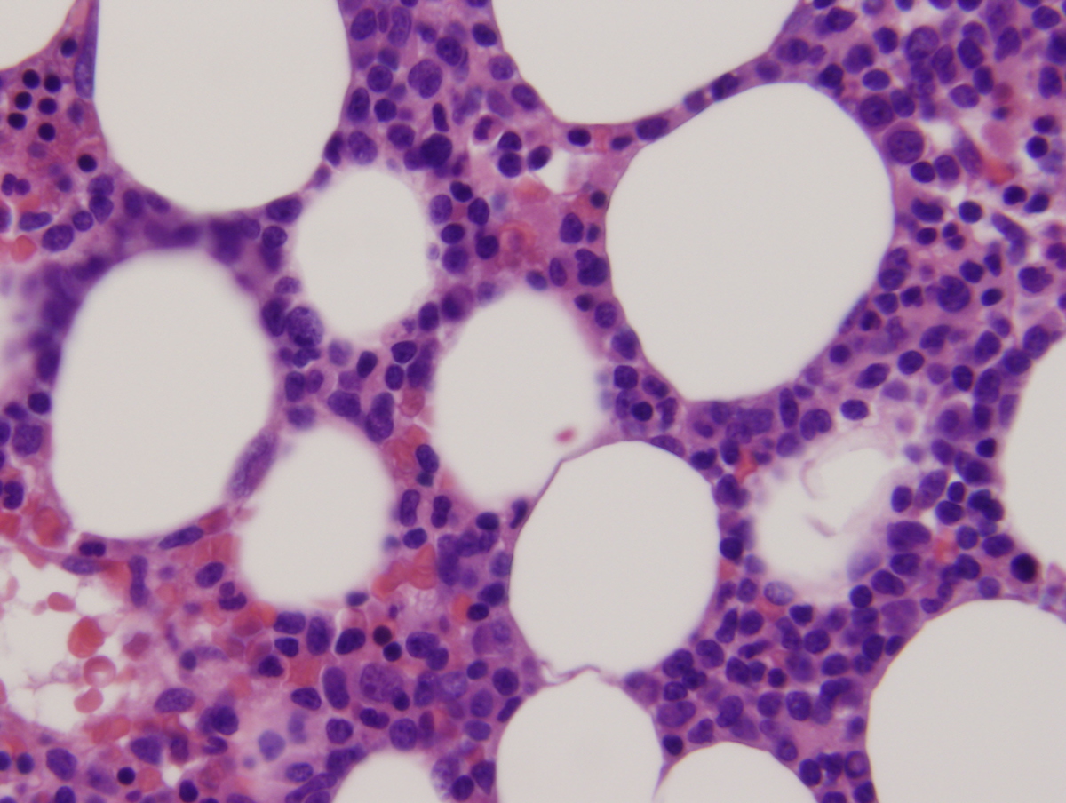 Bone marrow clot section showing increased blasts 1