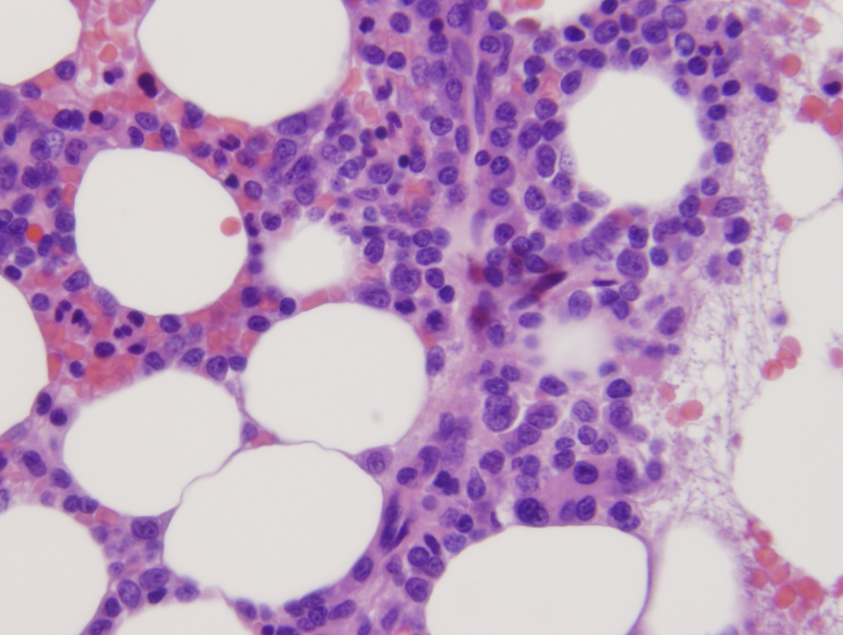 Bone marrow clot section showing increased blasts 2