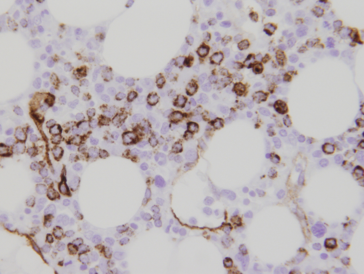 CD34 immunostain highlights blasts