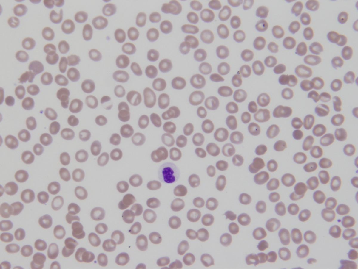 Peripheral blood: dysplastic neutrophils 2